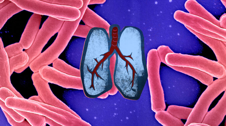 Tuberculosis image set behind a stylised illustration of human lungs